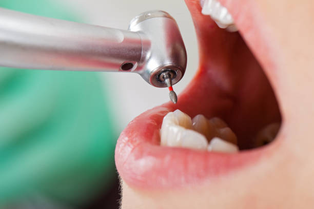 Best Emergency Dental Care for Broken or Chipped Teeth in Voorheesville, NY